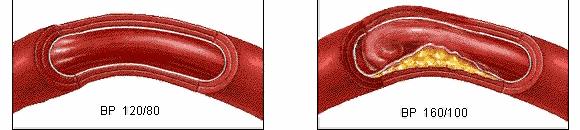 满口全瓷牙的明星李沁,李沁矫正牙齿前的照片