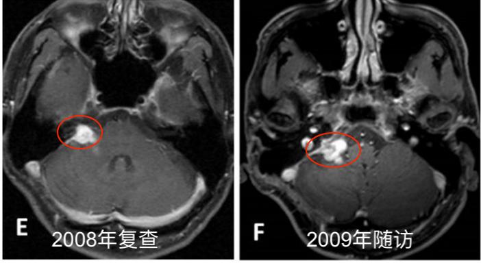 听神经瘤复发做二次手术,听神经瘤复发能要命吗