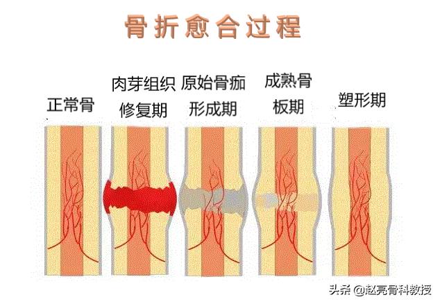 骨科吃什么术后伤口愈合最快,骨科咨询骨折后怎样恢复得快