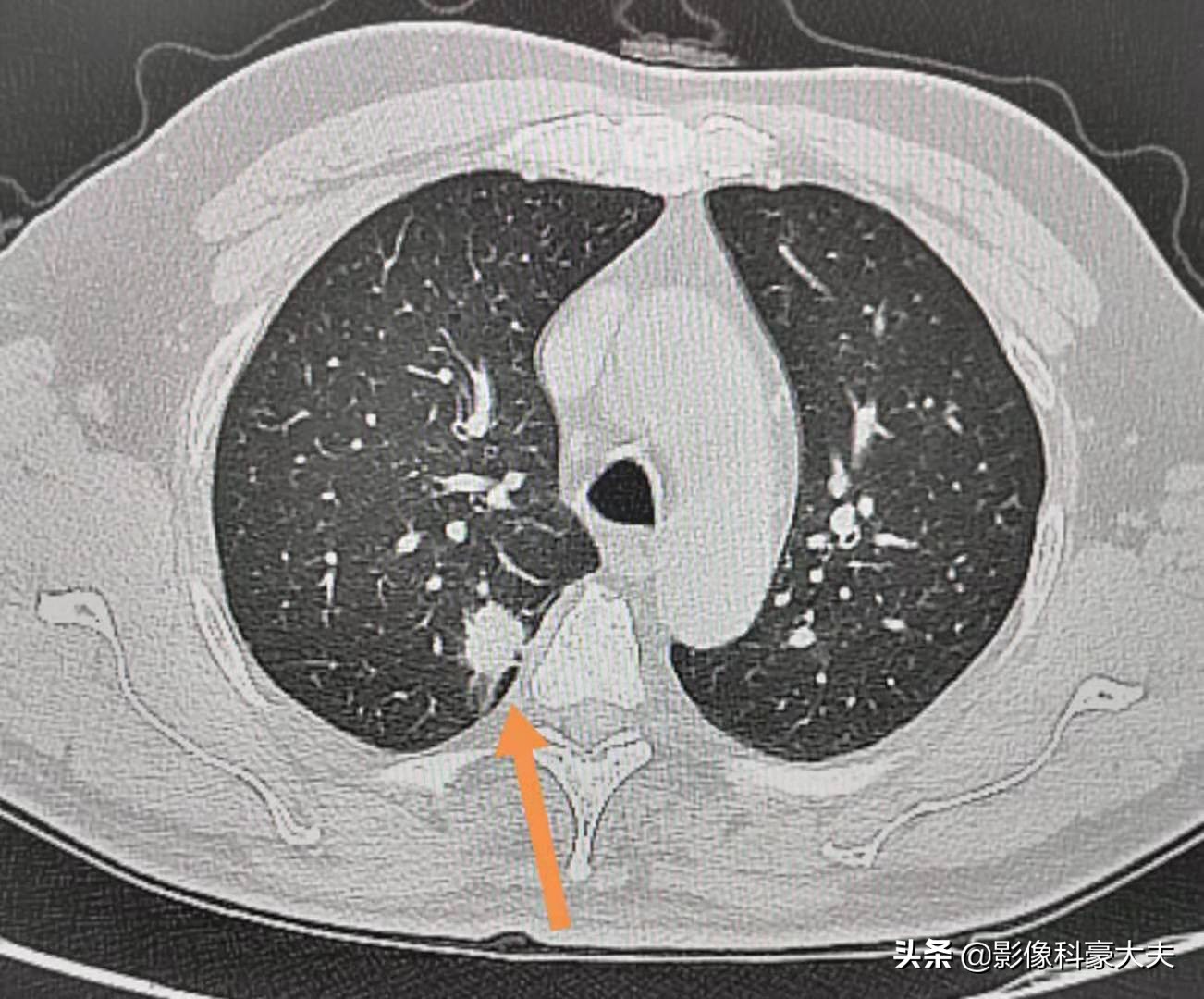 肺癌怎样才算局部晚期症状,肺癌分几种类型怎么吃药