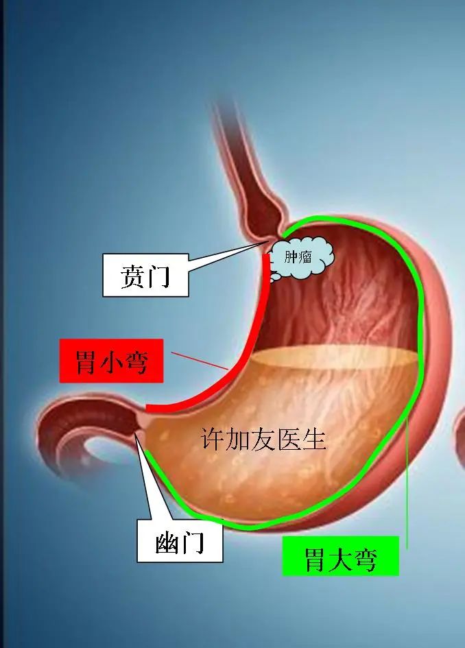 胃全切吃饭肚子疼,切胃了怎么吃饭