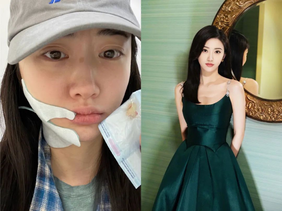 景甜素颜曝光认不出，自拍双眼皮疤痕明显，曾大方承认自己整容