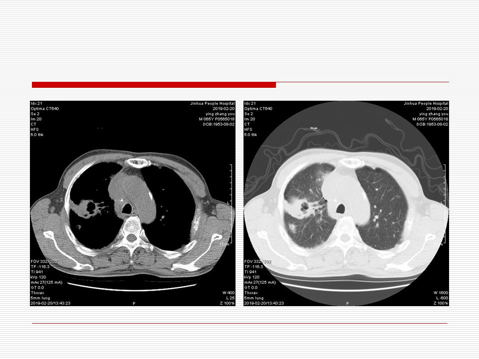 像炎症的肺癌能治好吗,医生说可能是肺癌也可能是炎症