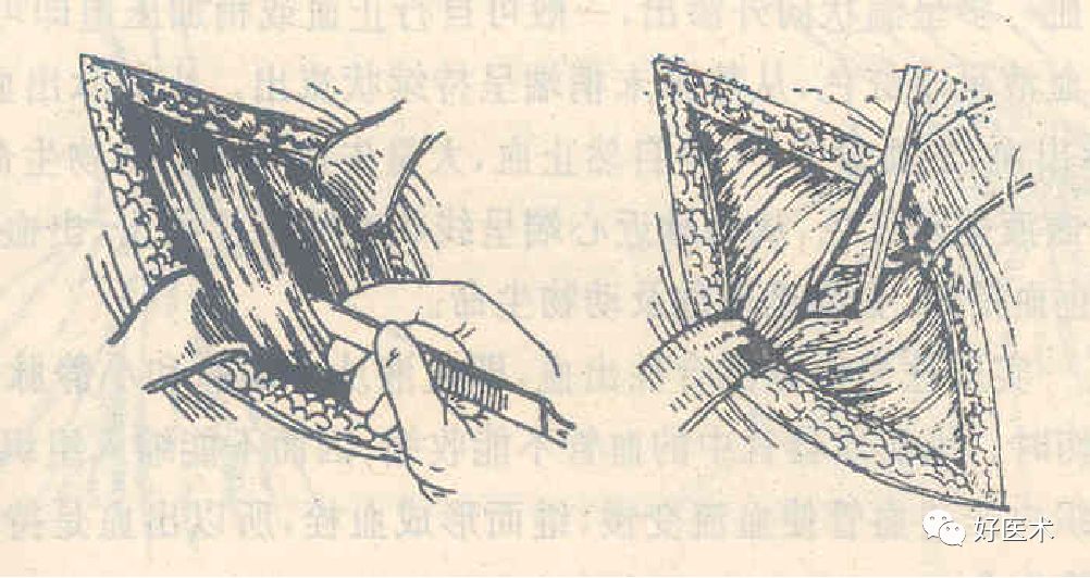 气管切开注意事项,切开引流注意事项