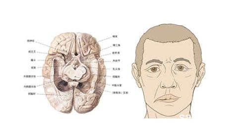 面神经麻痹，嘴巴歪了还能不能好起来？歪嘴巴纠正方法