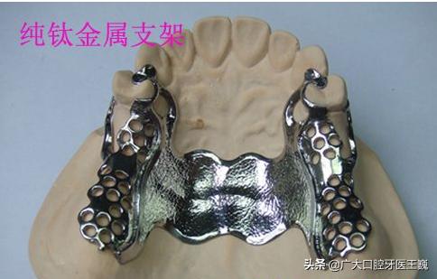 较好的活动义齿能用多久,目前最先进的活动义齿