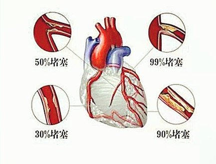 胸口压榨疼几分钟缓解,胸口有压榨性疼痛吃什么药
