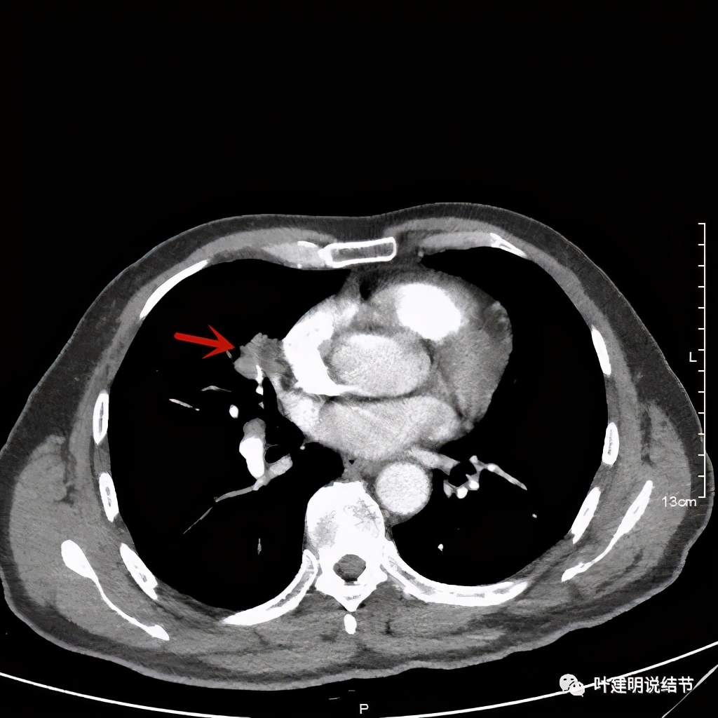 实性结节影要不要紧,实性结节穿刺活检为良性