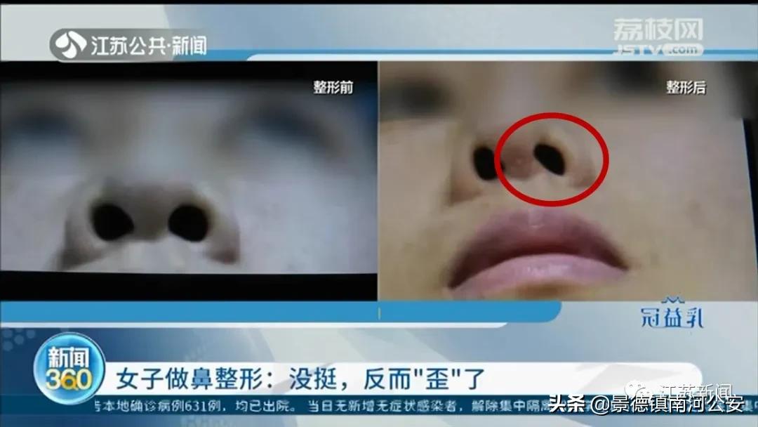 整容鼻头歪了如何修复,女子整容后全身颤抖