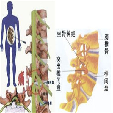 腰三横突综合征疼痛缓解方法,第三腰突综合症腰疼怎么治疗