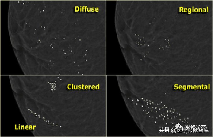 乳腺钙化怎么区分良性和恶性,乳腺钙化的诊断与分级