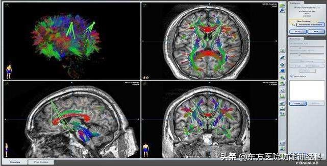 精神病手术治疗的效果如何,手术治疗难治性精神疾病