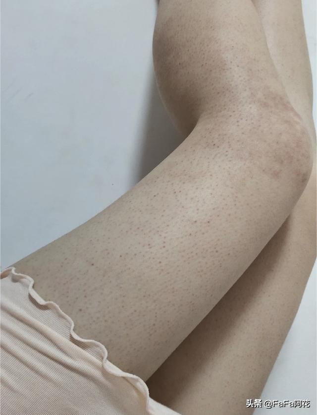 腿上鸡皮肤是什么引起的,小腿上的鸡皮肤怎么治疗