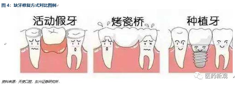 种植牙市场现状,种植牙暴利之谜