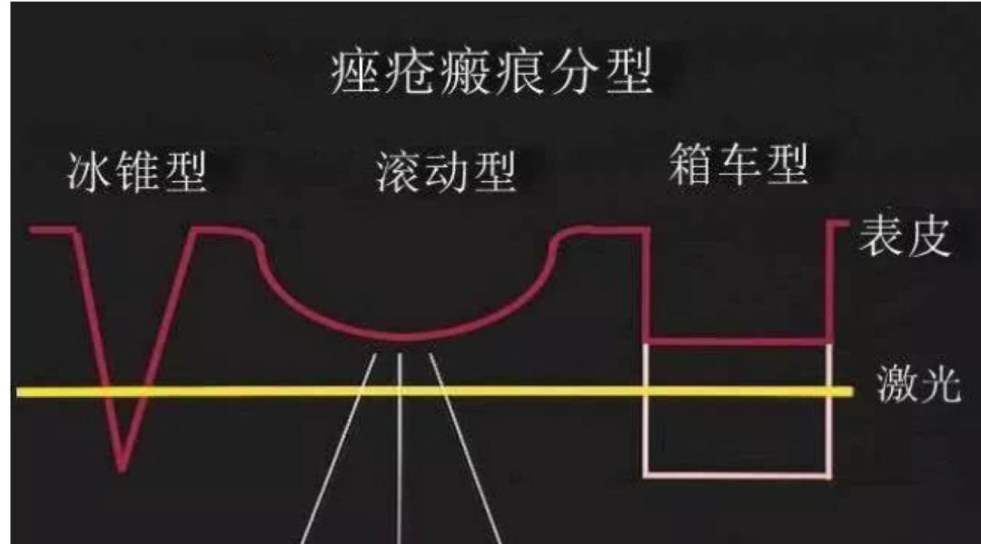 很多小痘坑修复好能和以前一样吗,顽固黑头痘坑