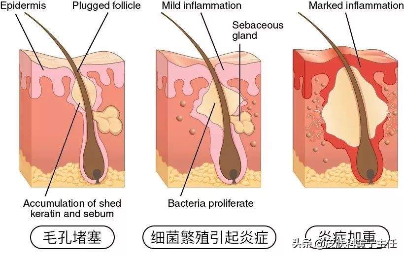 宅家的1个多月都没化妆,竟然还爆痘