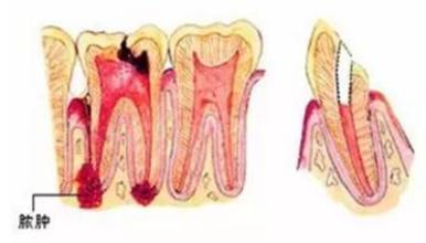 口腔科医生：什么是牙髓炎？牙髓炎主要有哪些症状？