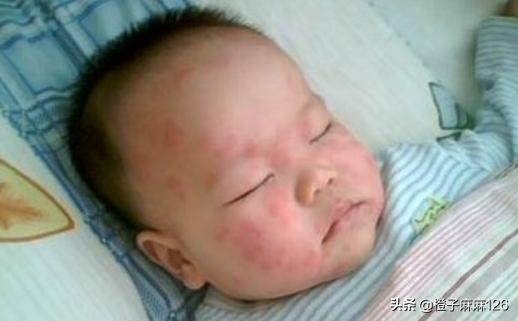 婴儿脸上起疹子跟母乳有关系吗,婴儿脸上有小疹子颗粒怎么消除