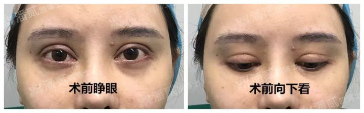 欧式大双眼皮和平行双眼皮,醒醒吧明智的放弃胜过盲目的执着