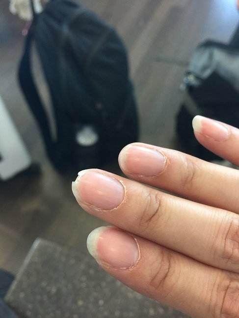 指甲盖被劈了咋办,指甲盖长劈了一半