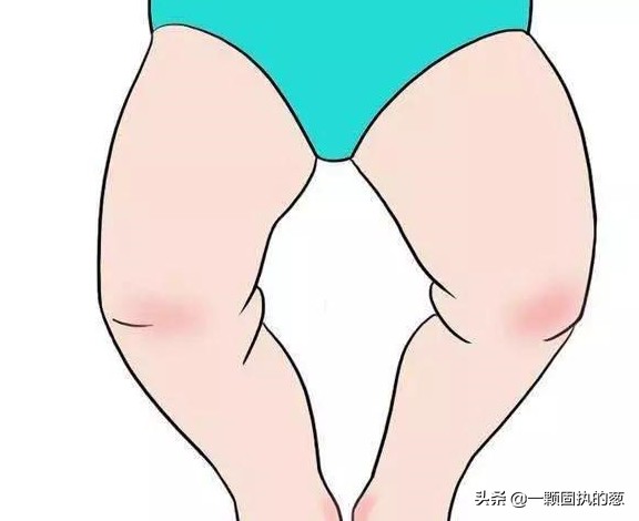新生儿有o型腿是什么原因造成的,一岁2个月宝宝o型腿绑腿多久能好
