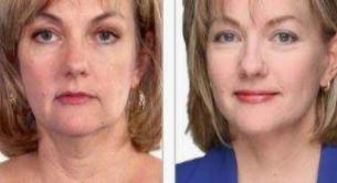 锻炼面部肌,锻炼面部肌肉视频教程