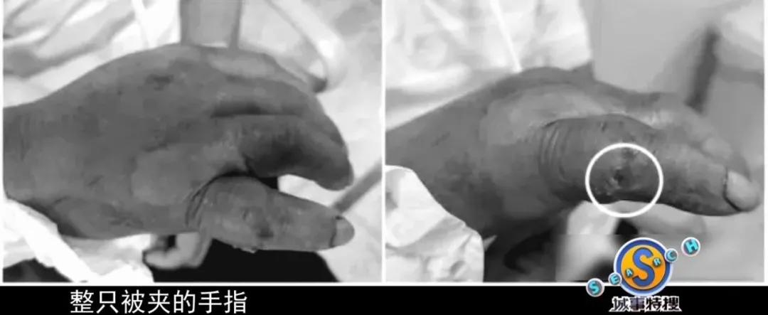 男子被钳子夹住致命部位,男子被咬一口全身器官衰竭