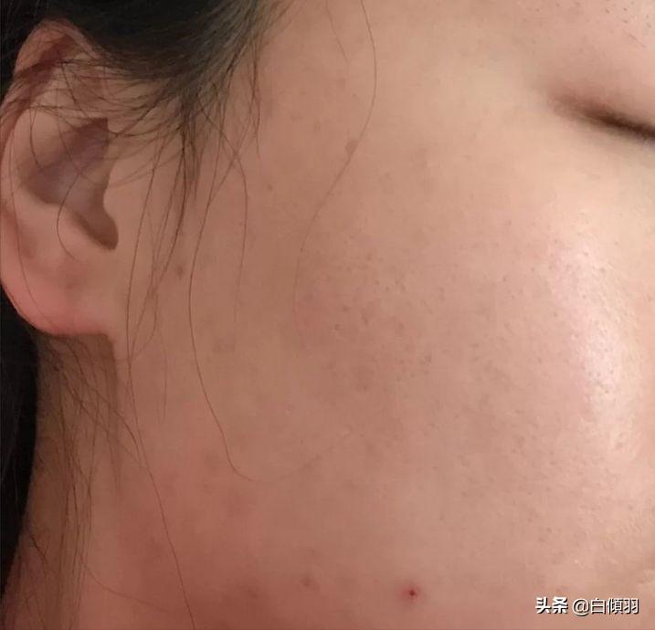 痘痘红肿发硬但是没白色脓头很疼,红肿痘痘疼不冒头也不消怎么办