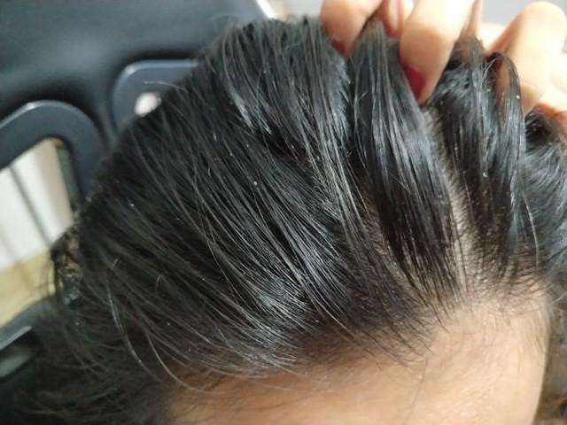 头发易出油头皮多怎么回事,头皮上有螨虫头发掉怎么办