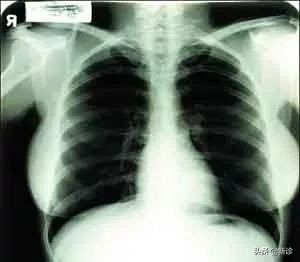 刚怀孕拍了胸片孩子能要吗,体检拍胸片后多久能怀孕