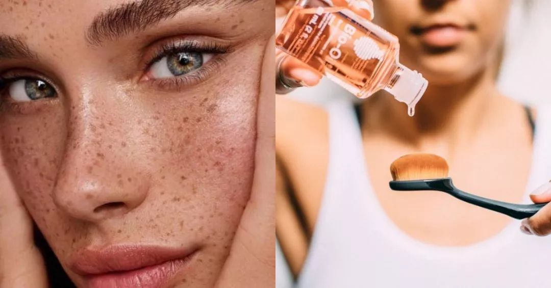 去妊娠纹的油有效果吗,去妊娠纹的油推荐