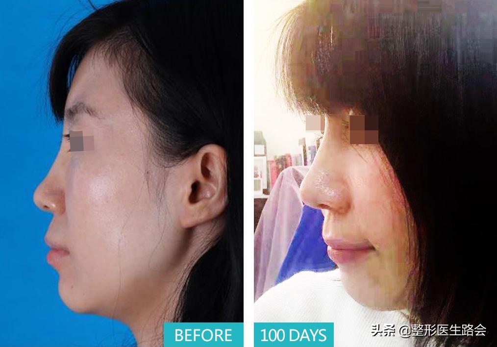 硅胶隆鼻会破坏原来的鼻子吗,隆鼻硅胶可以永久不取吗