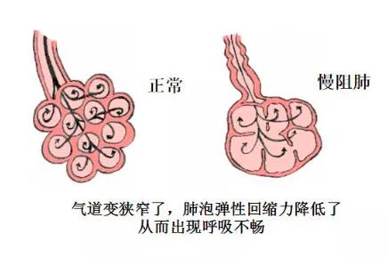 慢阻肺痰如何减少或根除,慢阻肺是痰阻塞气道吗
