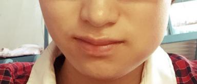 拔除智齿有什么副作用吗,拔除智齿脸会小吗还是下垂