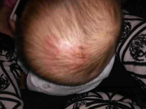 小孩后脑勺着地昏迷怎么样了,小孩头着地的严重性