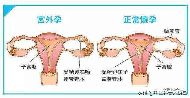 一分钟判断宫外孕的方法,简单判断宫外孕