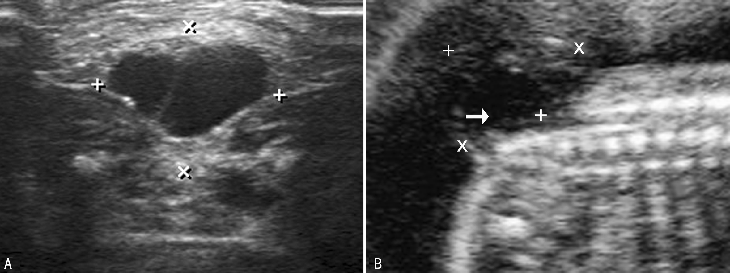明明白白做超声25-5：胎儿神经管缺陷—脊柱裂