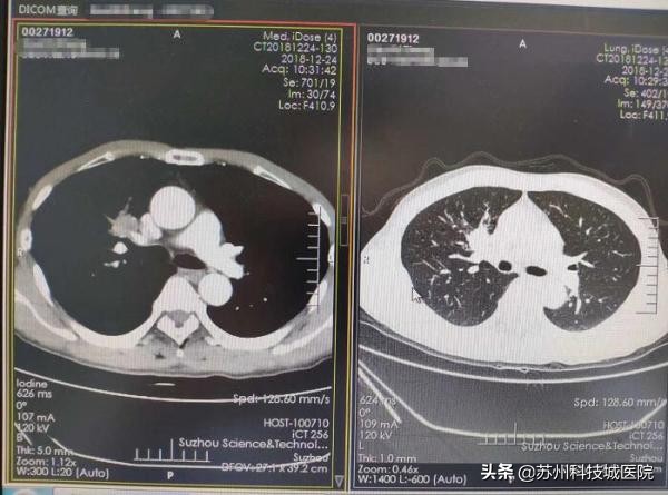 拯救老烟枪！苏州科技城医院单孔下成功切除中央型肿瘤