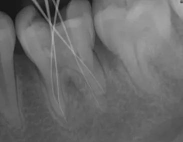 为什么牙疼起来真要命,牙疼不是病疼起来真要命