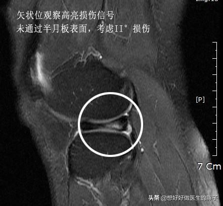 膝关节核磁共振报告单上怎么看,膝关节核磁正常报告单