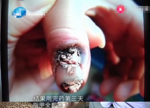 8岁男童治疗刺猴，遵医嘱后却甲床坏死，竟是内科医生治疗外科病