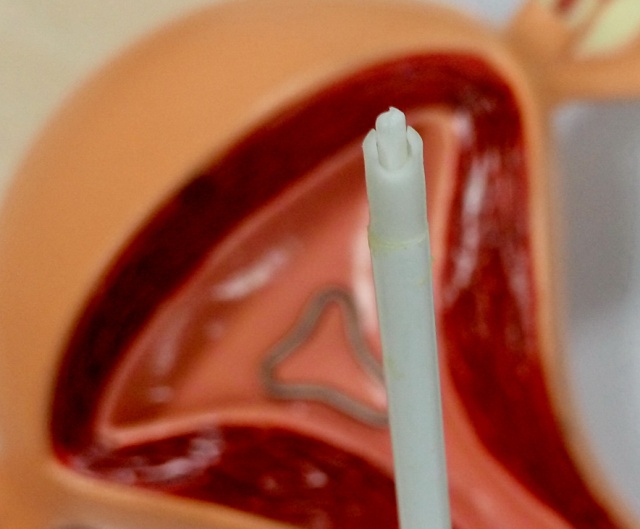 宫内节育器和节育环有什么区别,宫内节育器避孕环