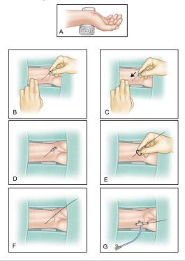 无保护单臂大回环,无保护左主干