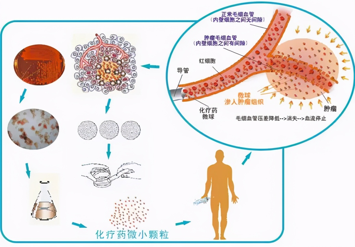 直肠癌骶骨转移复发怎么办,直肠癌复发转移到肝上怎么治疗