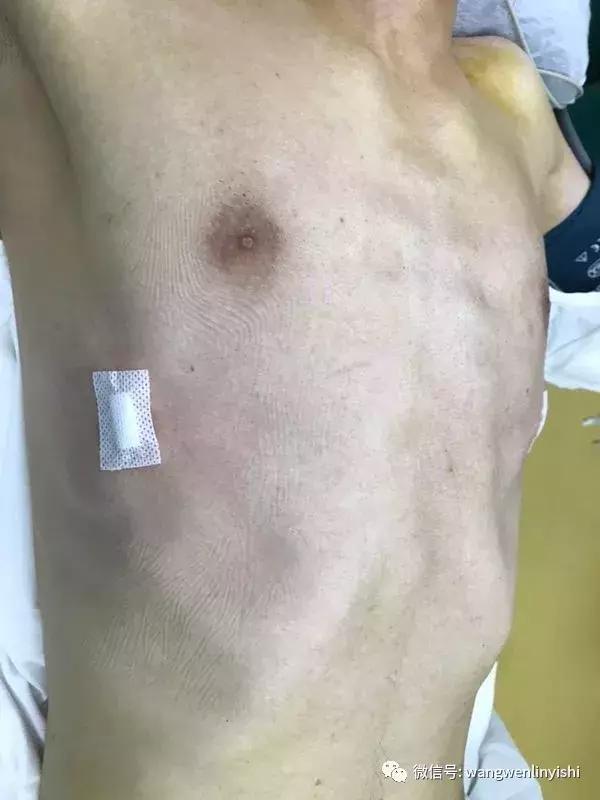 胸壁开放性手术恢复全过程,胸壁清创缝合术