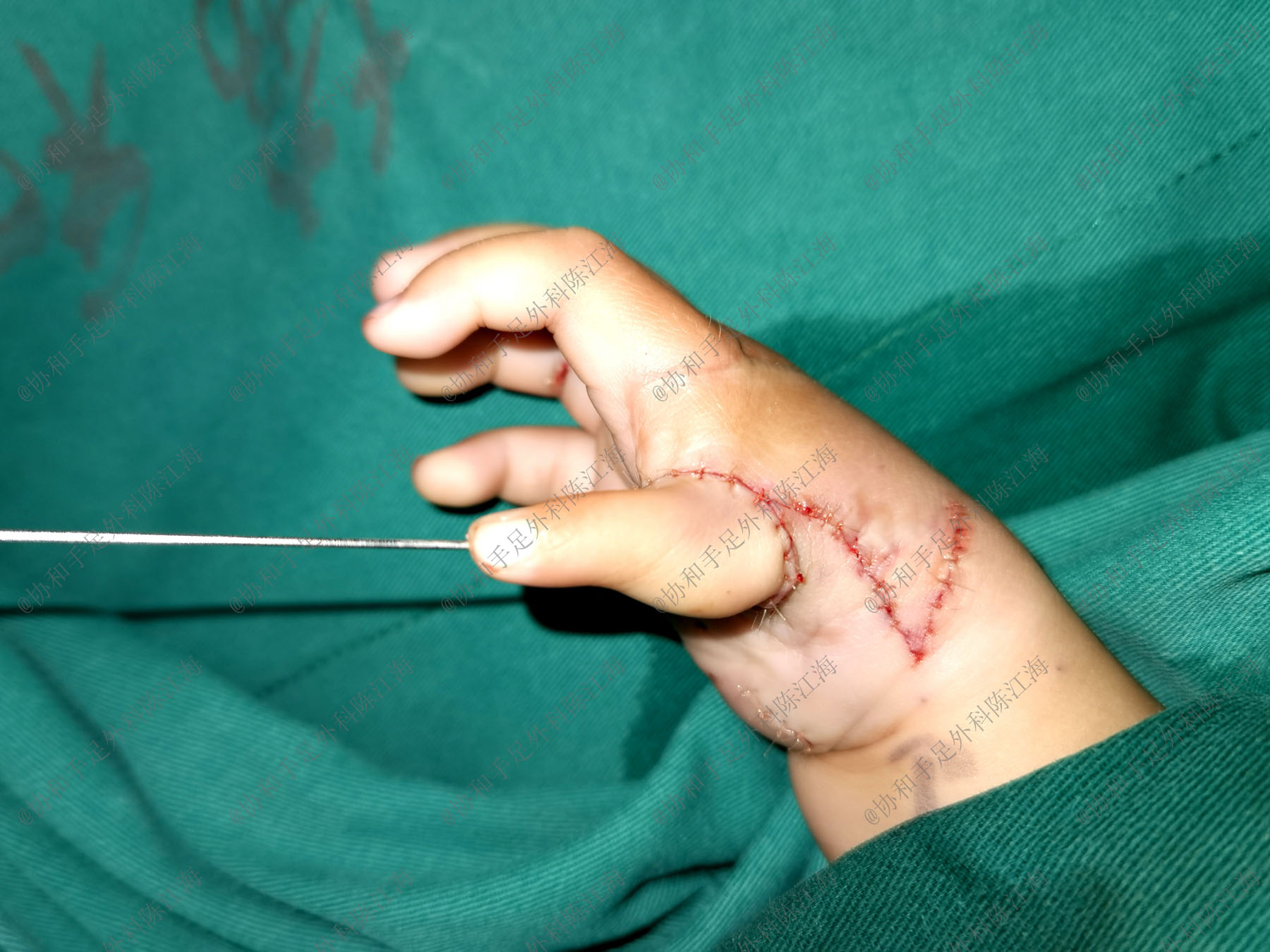 婴儿怎么看手指发育情况,宝宝手指多指是什么原因造成的