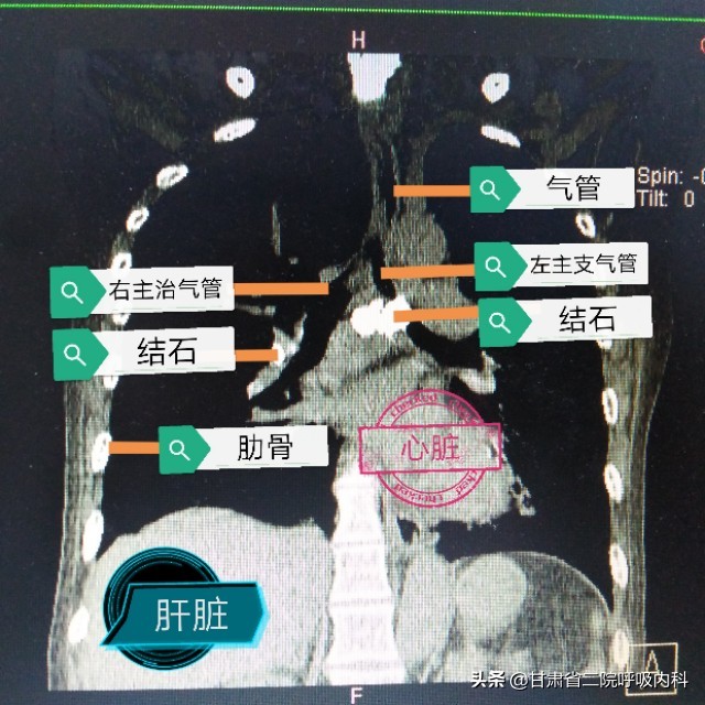 喉咙里面真的有石头吗,喉咙里会长石头吗