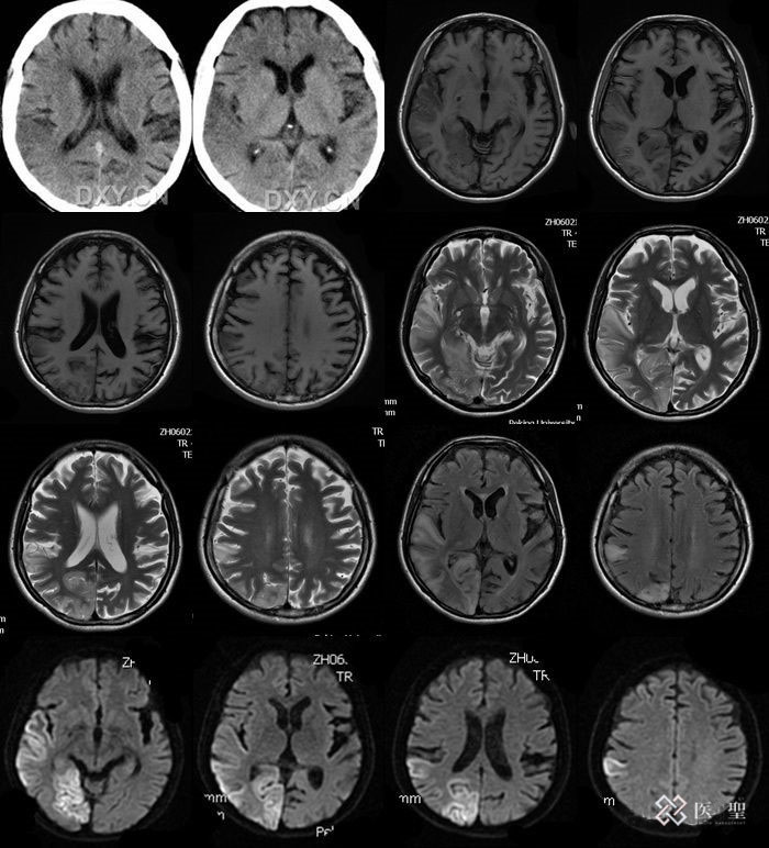 对肺癌晚期的最新治疗,正确认识和应对肺癌