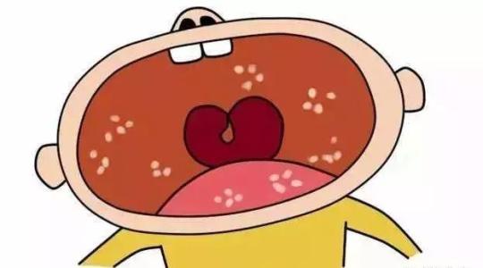 宝宝舌苔厚和鹅口疮的区别,宝宝口腔奶渍和鹅口疮的区别