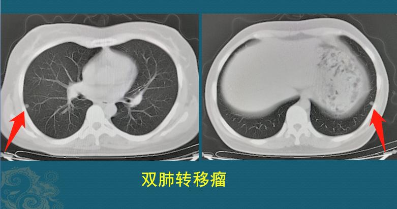 32岁女子抗癌19年相继患上5种癌,癌细胞转移最难治疗方法